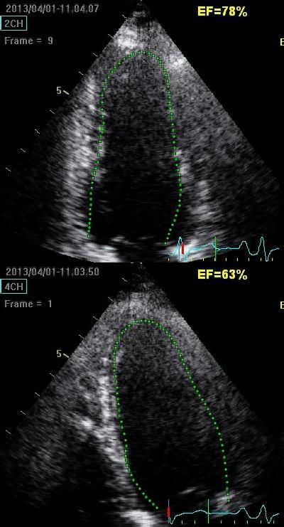 speckle pattern of myocardial region can assess rotational motion/