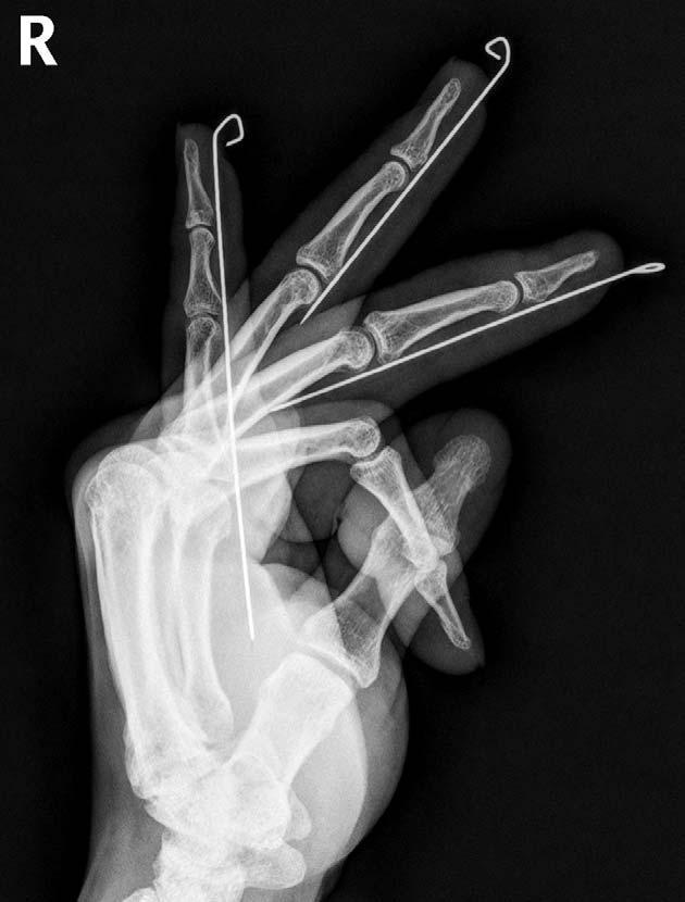 Jun Hee Lee, et al. Finger Immobilization by K-Wire is not uncommon. In addition, wire removal is painful and requires special instruments.