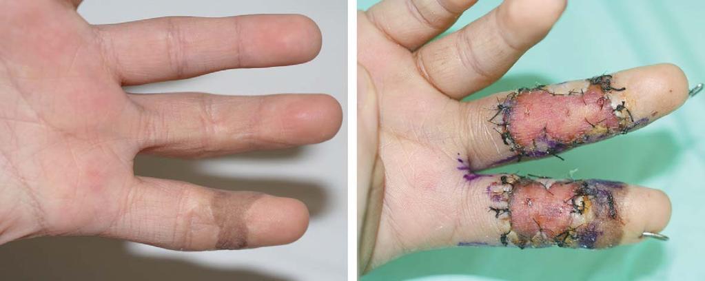 J Korean Soc Surg Hand Vol. 20, No. 1, March 2015 Fig. 2. Case 1. (A) A10-year-old child with burn scar contracture on the volar side of the ring and little fingers.