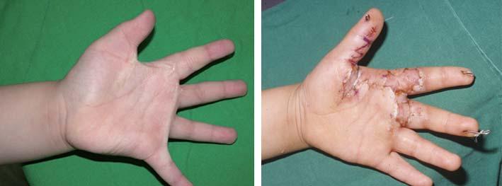 Jun Hee Lee, et al. Finger Immobilization by K-Wire Then, the K-wire was inserted through the soft tissues on the volar side for finger immobilization.