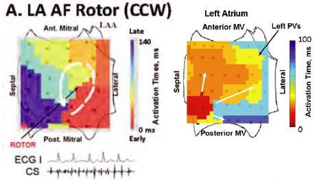 Figure 2.12 Left Atrial Rotor Source (Left) and Focal Beat Source (Right) 52 This figure shows examples of rotor sources and focal beat sources found using the mapping methods.