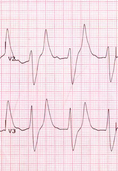 ECG abnormalities in hyperkalaemia Prolonged PR Wide QRS, sine wave, arrhythmias Tented T waves Flat p waves 5.0 5.5 6.0 6.5 7.0 7.