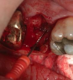 st molar extraction.