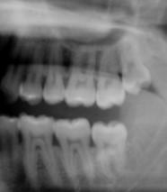 third molar.