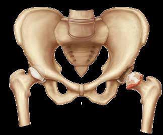 HEALTHY HIP ARTHRITIC HIP What causes severe hip pain? Pain is one of the main reasons people consider total hip replacement surgery.