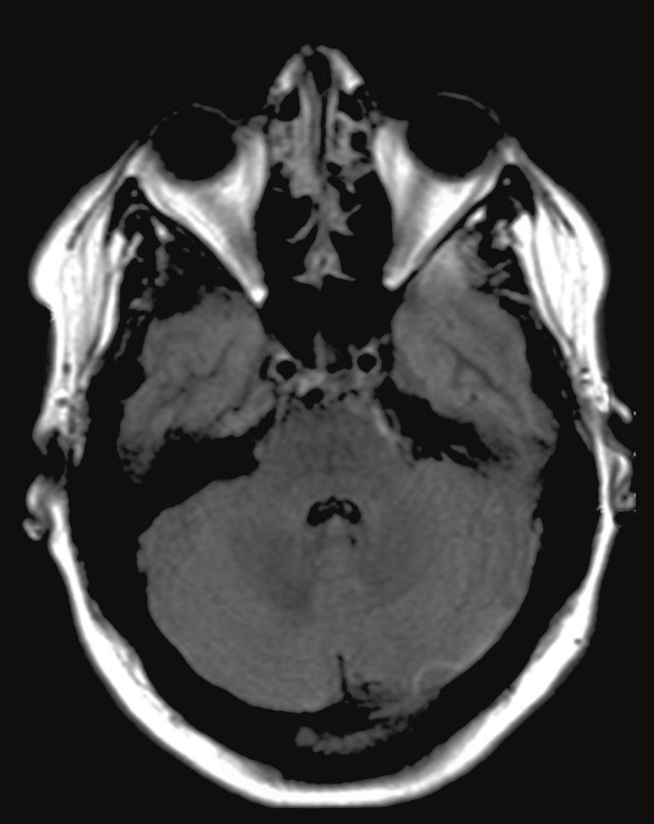 Figure 3: followup MRI examination