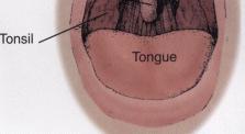 pharyngeal mucosal folds A low palatal arch with a long soft palate Large tongue, mandibular retro or microganthia