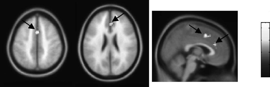Figure 5. ERP and fmri task-switch effects in the WAIT task. (A) Left: Topography of the switch versus nonswitch effect on WAIT trials over the 500 800 msec time range.