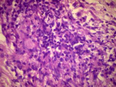 Histological features of lepra reactions 57 Figure 3. Biopsy during reaction. Compact epithelioid granuloma with Langhan s giant cells and heavy lymphocytic infiltrate.