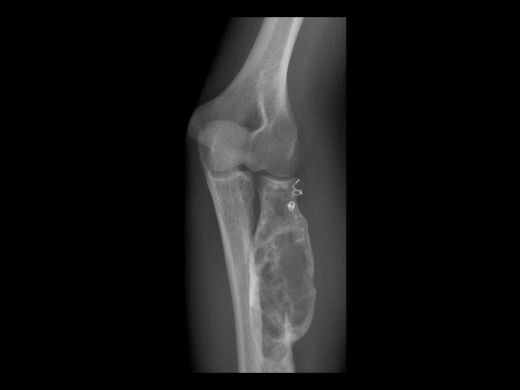 Fig. 10: Aneurysmal bone cyst of the radius.