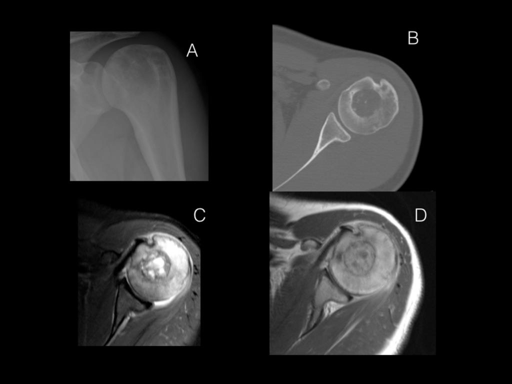 Fig. 14: Chondroblastoma of the left humerus. A) Anteroposterior radiogram of the left shoulder. We can see a faint lytic lesion in epiphysis. B) Axial CT of the same case.