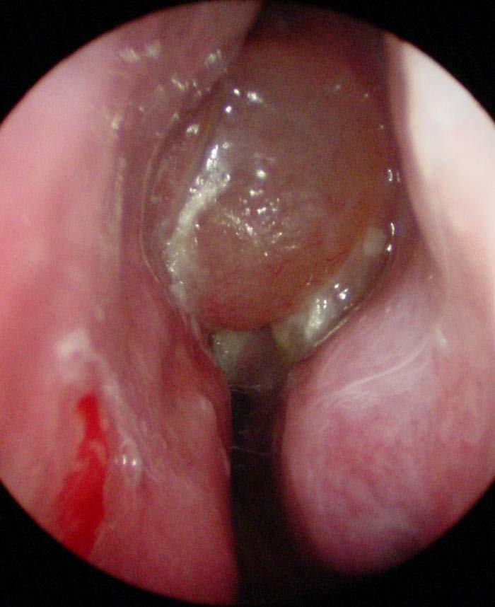 Nasal endoscopy Polyps, ostiomeatal unit obstruction, adenoid hypertrophy Nasal smear Obtained from