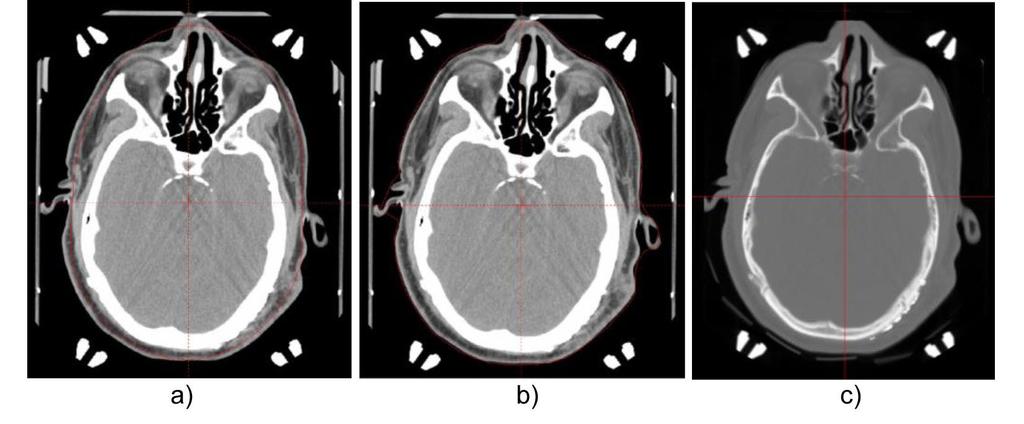 121 Xu et al.: Gamma Knife dose calculation 121 acoustic neuroma, arteriovenous malformation (AVM), glioma, and benign and metastatic brain tumors.