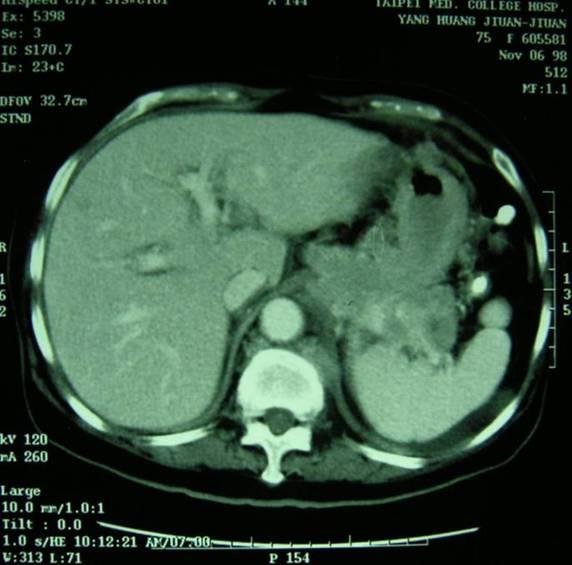 CT Thickened gastric wall Soft tissue