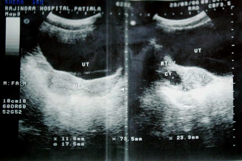 (Figure 1)-Both the longitudinal and transverse ultrasound