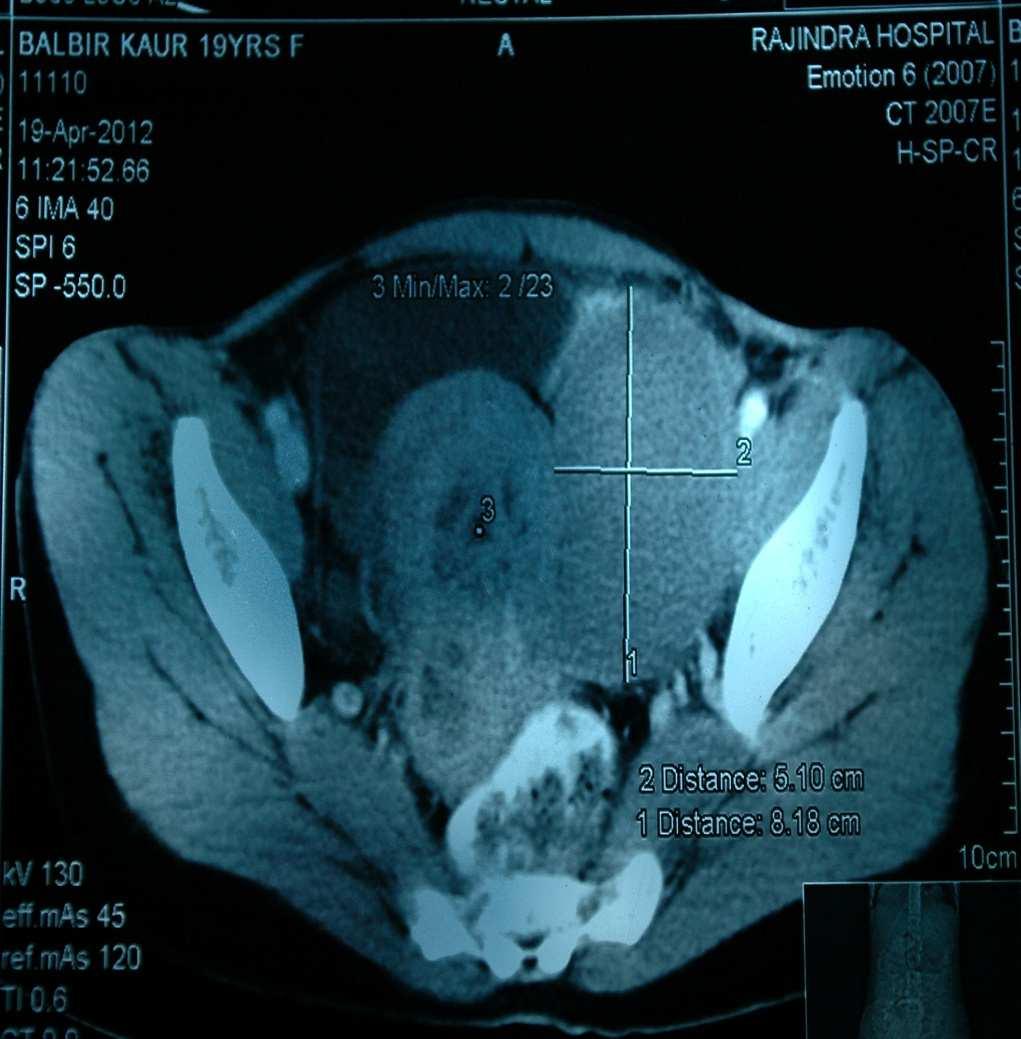 (Figure 3) Show well defined thin walled cystic mass