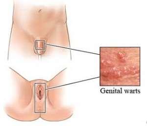 Viruses Genital Warts: group of papilloma viruses Increased risk of cervical cancer Warts can be removed by surgery