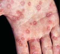 Bacterial infections Syphilis - serious Easily spreads though contact with sore during vaginal, anal,