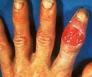 lesion disappears, secondary syphilis appears Skin rash, flu like symptoms Tertiary