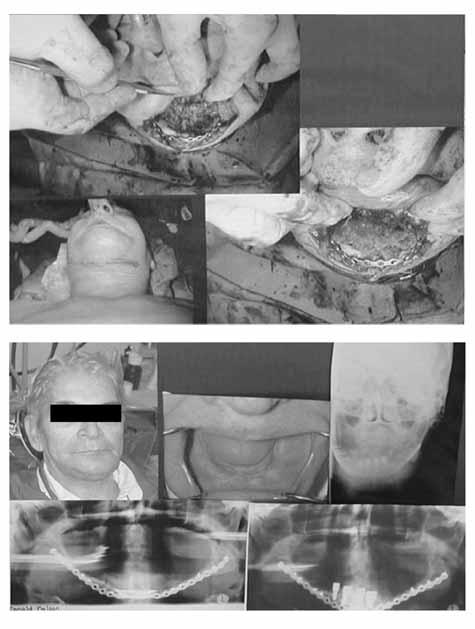 It was noted that mandibular bone, particularly in older individuals could not be reliably drilled with a self-drilling screw. In such cases predrilling was necessary.
