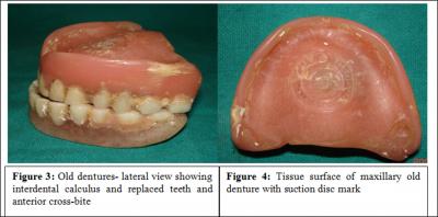 Figure 2 Figure 3 After evaluation and diagnosis, new complete dentures were planned to provide masticatory efficiency, retention and stability, to restore vertical height, correct centric relation