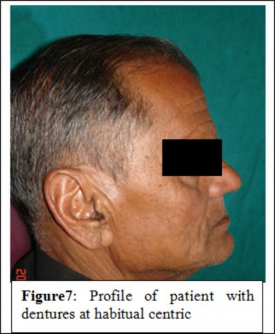 Figure 4 compromised the stability of the lower denture.