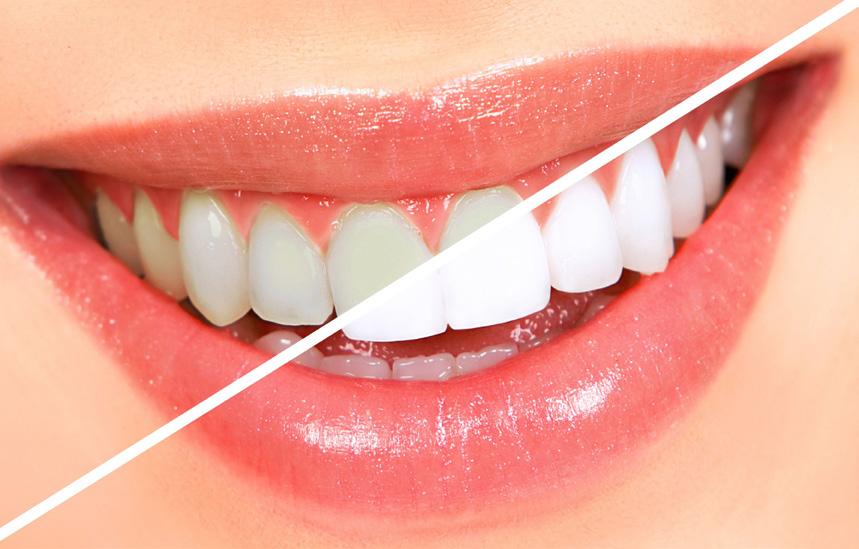 Q. What is tooth whitening? A. Professional tooth whitening is an effective way of lightening the natural colour of your teeth without removing any of your tooth s surface.