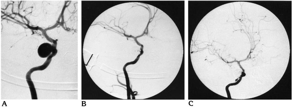 1654 CEKIRGE AJNR: 17, October 1996 Fig 3. Aneurysm on the right internal carotid artery (ICA) in a 4-year-old patient.