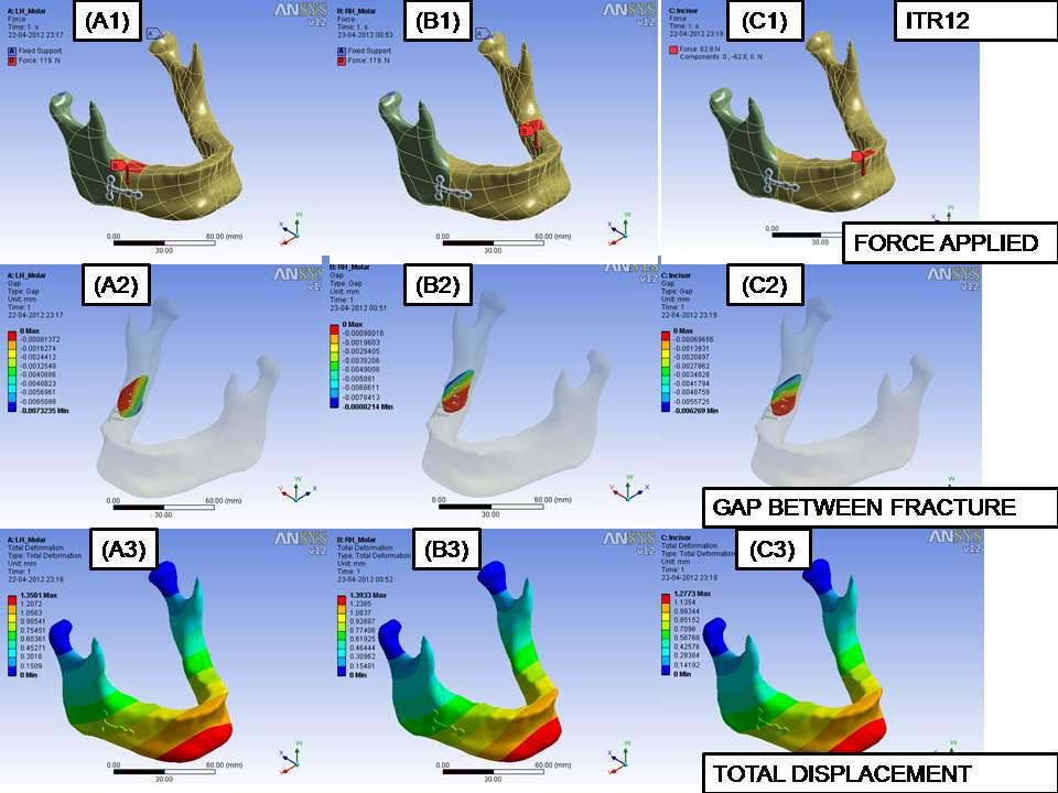 Joshi et al Figure 6 - FEM Model Setup & Results of ITR12 (T2 Plate) A1: indicates bite load application on molar left hand side.