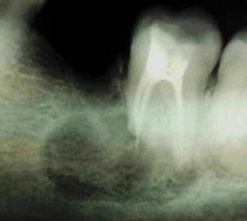 Figure 1 Radiograph of RCT of 47 showing Over-obturation and Periapical Lesion Studies have demonstrated that part of the root canal spaces often didn t prepared during biomechinical preparation may