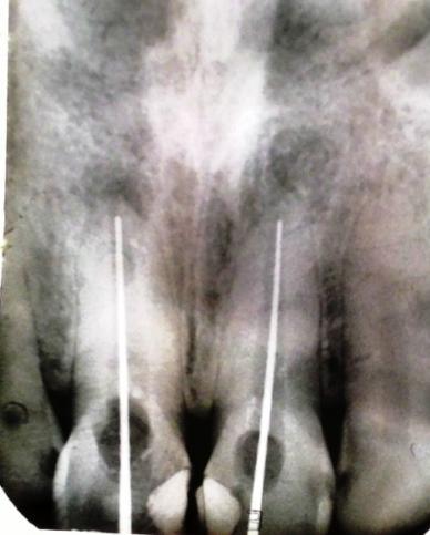 But due to over instrumentation especially in relation to 11 tooth even the 80 No. GP was crossing the apex so had to be suitably cut to fit at the apex whereas 60 N. GP was used in 21 for obturation.