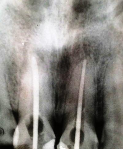 Fig 6 Pre Obturation Radiograph of 11, 21 After obturation was done and access cavity restored patient was asked to undergo crown preparation. 4.