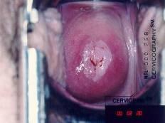 Potential cervical cancer