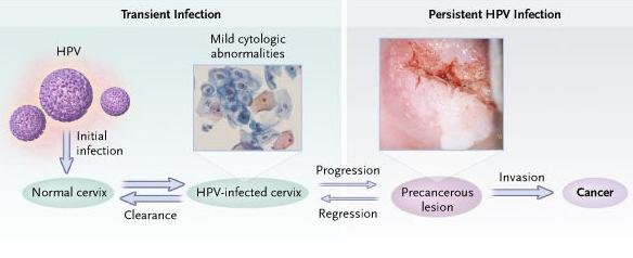 How cervical cancer develops Long latent period allows screening to detect precancer Source: Wright, TC and Schiffman, M.