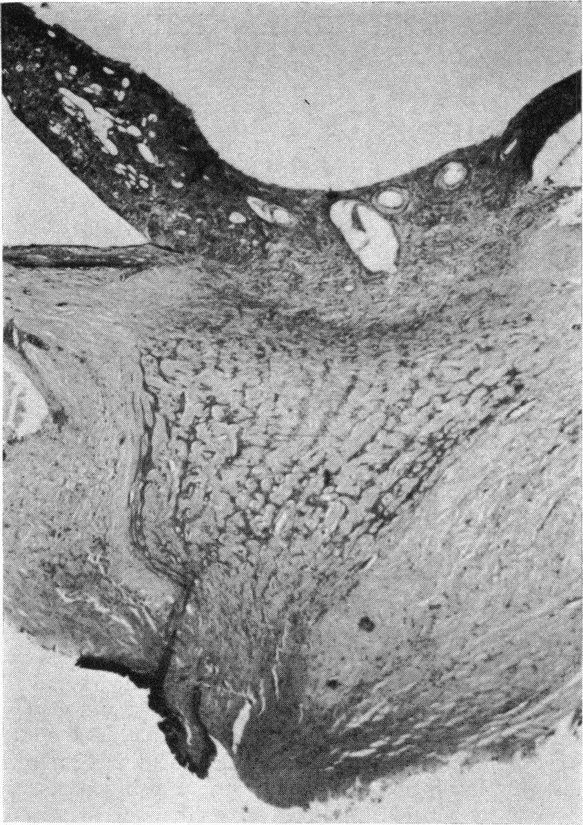 540 British Journal of Ophthalmology FIG. I Optic nerve and peripapillary retina of enucleated eye showing atrophic nerve and strip of conjunctival epithelium on posterior surface of specimen.
