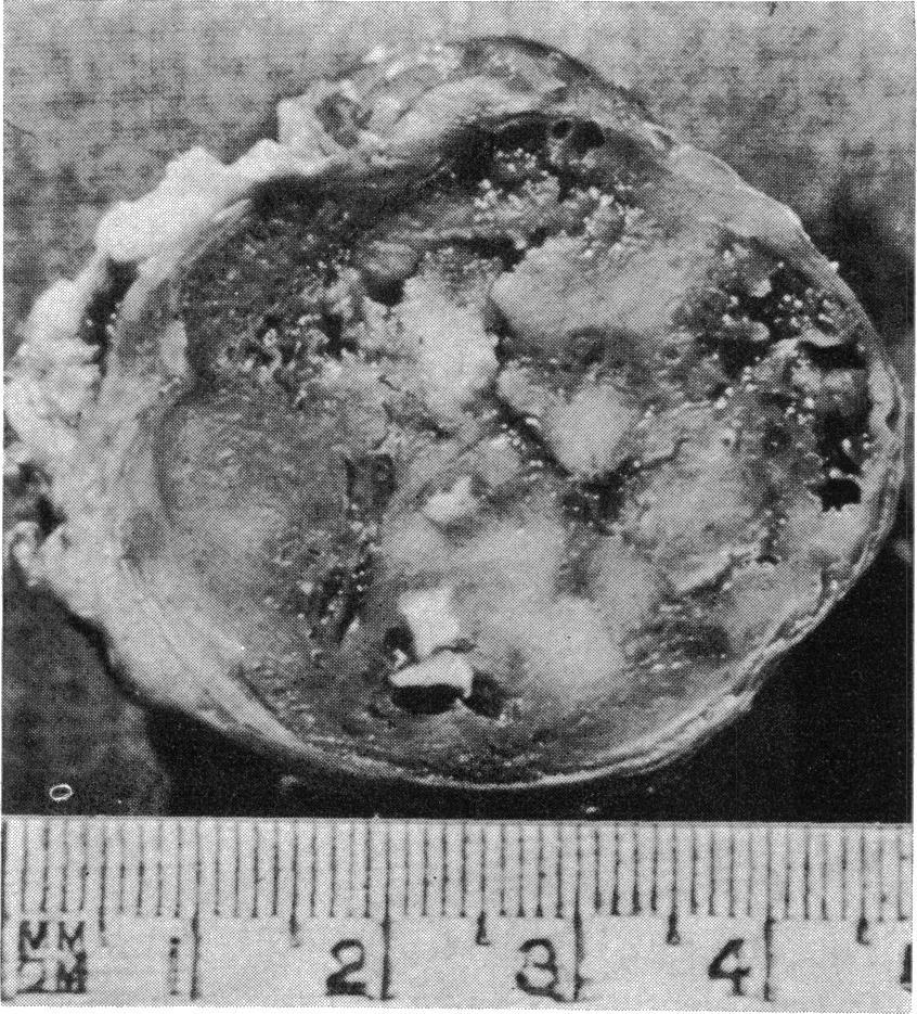 To confirm this diagnosis some of the formalin-fixed tissue was used for electron microscopy.