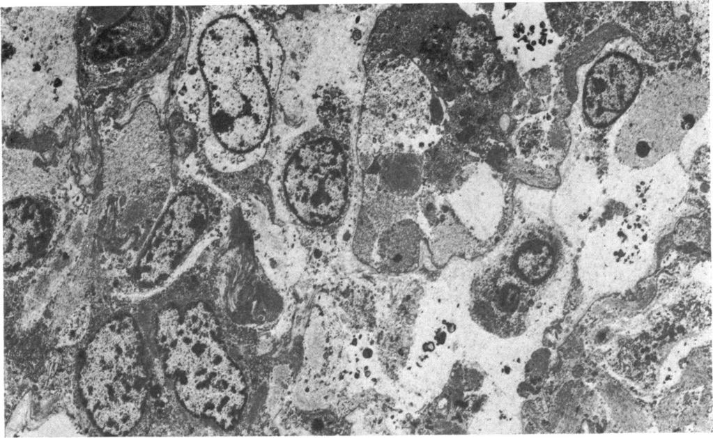542 British 3ournal of Ophthalmology FIG. 4 Low-power electron micrograph showing irregular size and shape of tumour cells and uneven distribution of nuclear chromatin. X 2200 4f FIG.
