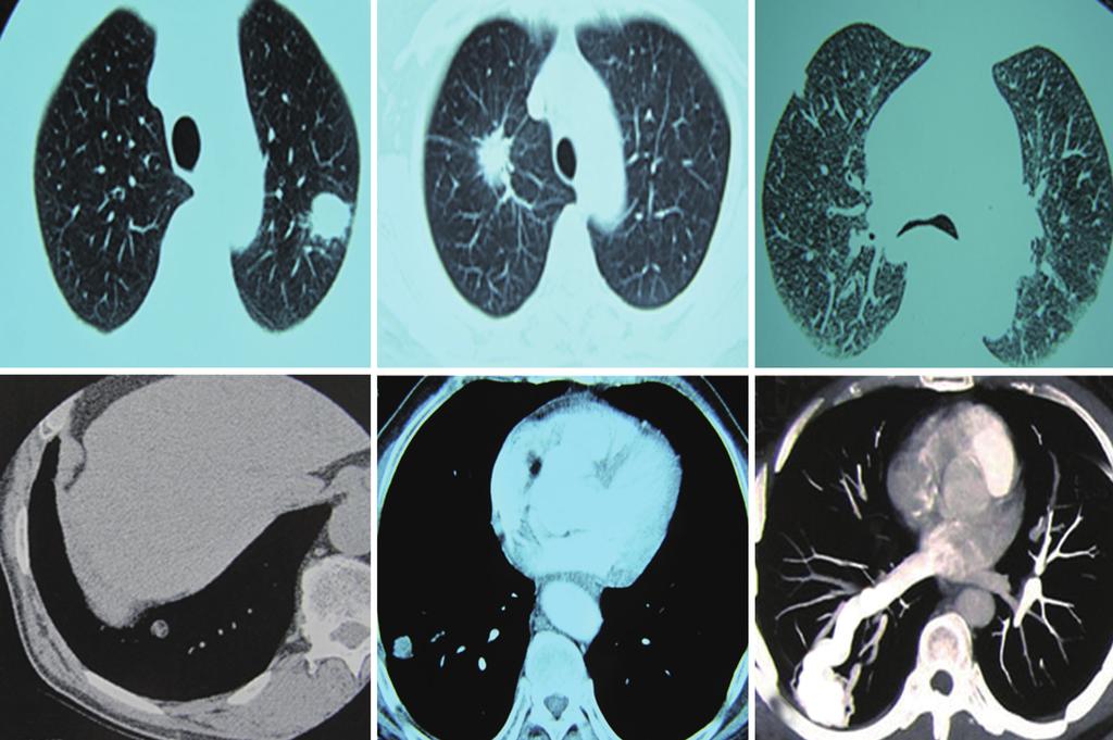 832 Xu et al. Diagnosis of solitary pulmonary nodules A B C D E F Figure 2.