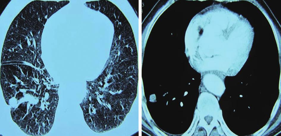 5. PET/CT shows right upper lung