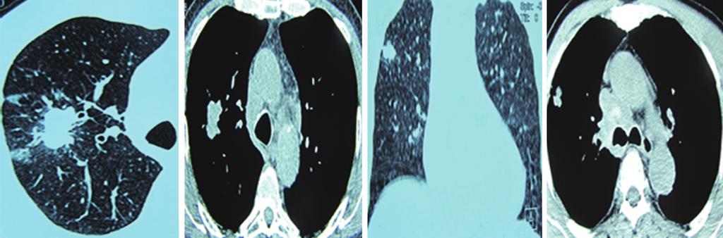 834 Xu et al. Diagnosis of solitary pulmonary nodules Figure 8. Lobulated nodule margins. Figure 9.