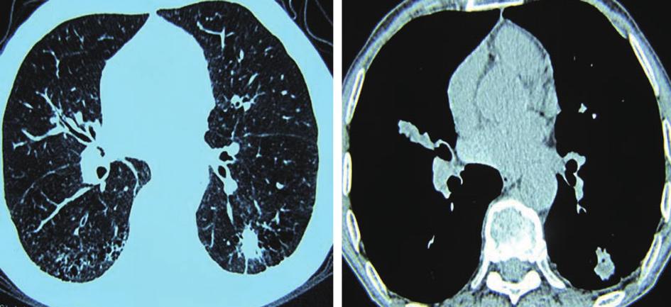 (16), of 132 SPN patients, 30% patients with lung cancer had aerated bronchi, while benign lesions presented only 5.9%.