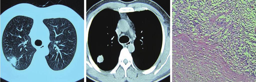 Satellite lesions around a SPN are commonly indicative of granulomatous inflammation in the lung The growth rate of nodules is commonly
