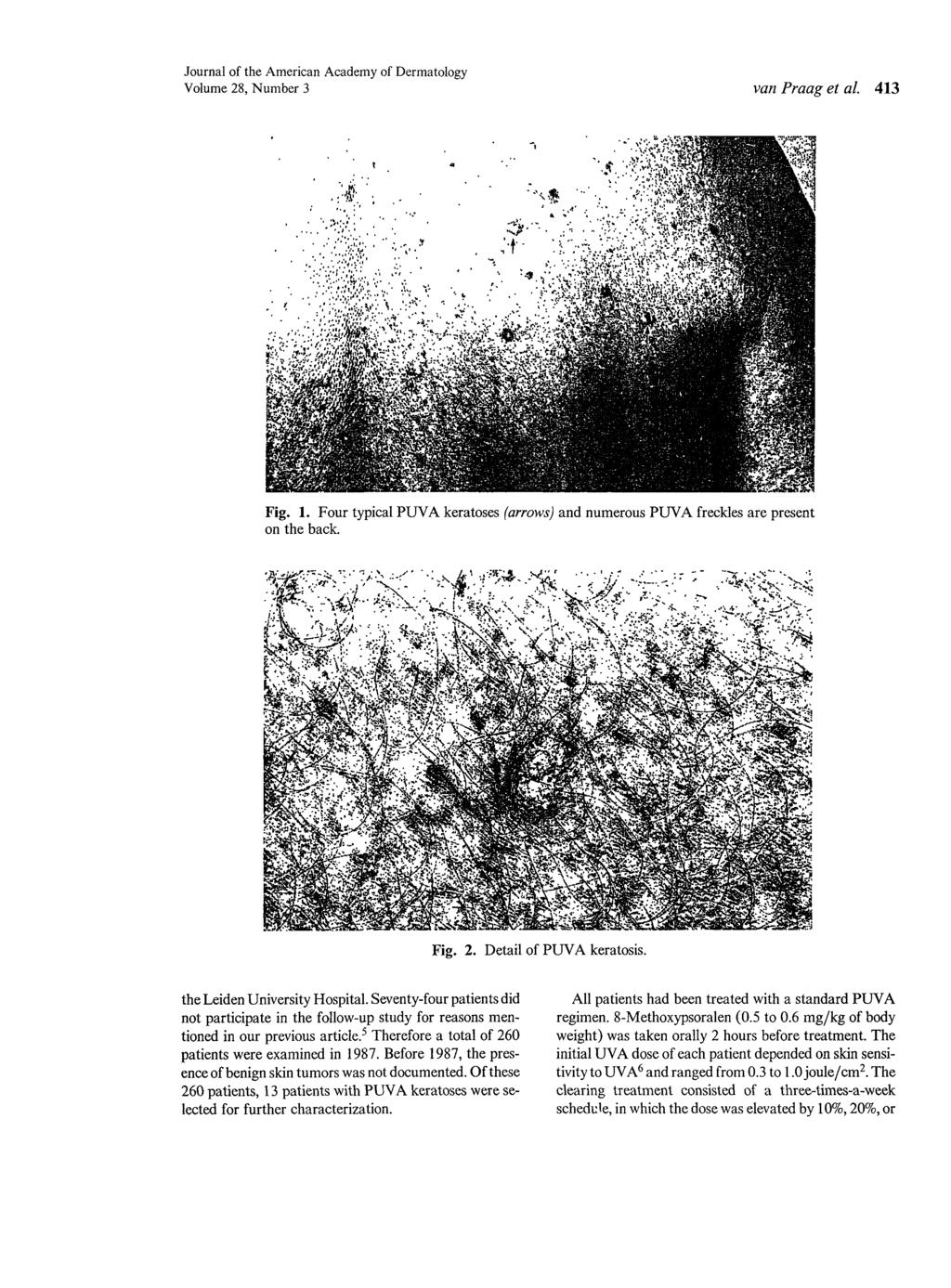 Journal of the American Academy of Dermatology Volume 28, Number 3 van Praag et al. 413 Fig. 1. Four typical PUVA keratoses (arrows) and numerous PUVA freckles are present on the back. Fig. 2. Detail of PUVA keratosis.