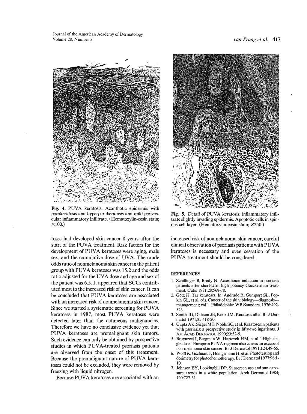Journal of the American Academy of Dermatology Volume 28, Number 3 van Praag et al. 417 Fig. 4. PUVA keratosis.
