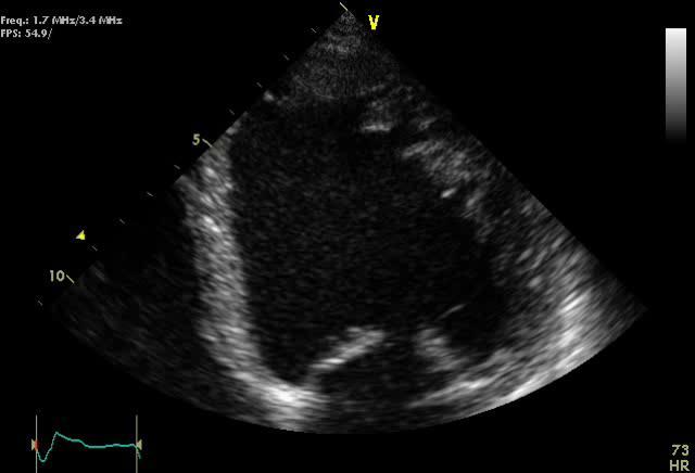 Cardiomyopathies Pts with dilated cardiomyopathy are at