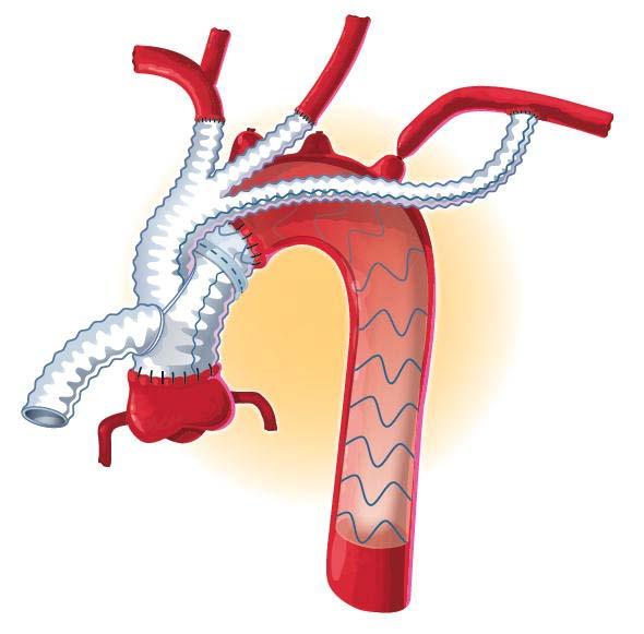 Acute Type A Aortic Dissection Primary Intimal Tear in Mid or Distal Arch Arch Aneurysm