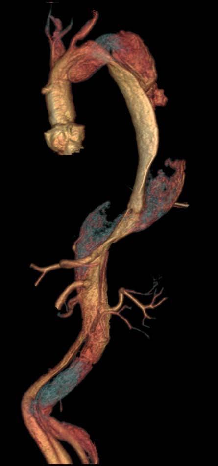course Aorta growing at rate of 1cm/year