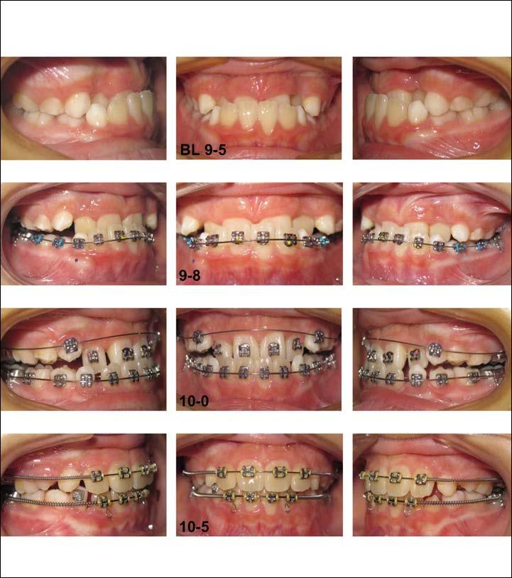 Correcting Anterior Crossbite Correcting anterior crossbite is desirable during the early mixed dentition period.
