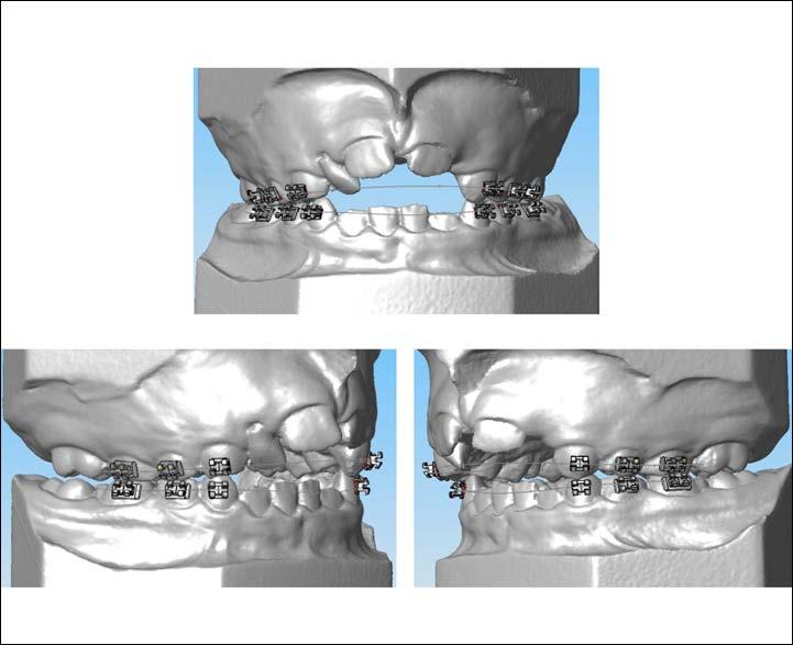 Expanding the mandibular buccal segments reestablishes arch coordination with the upper posterior teeth. It also creates space for the alignment of the permanent incisors by increasing the arch width.
