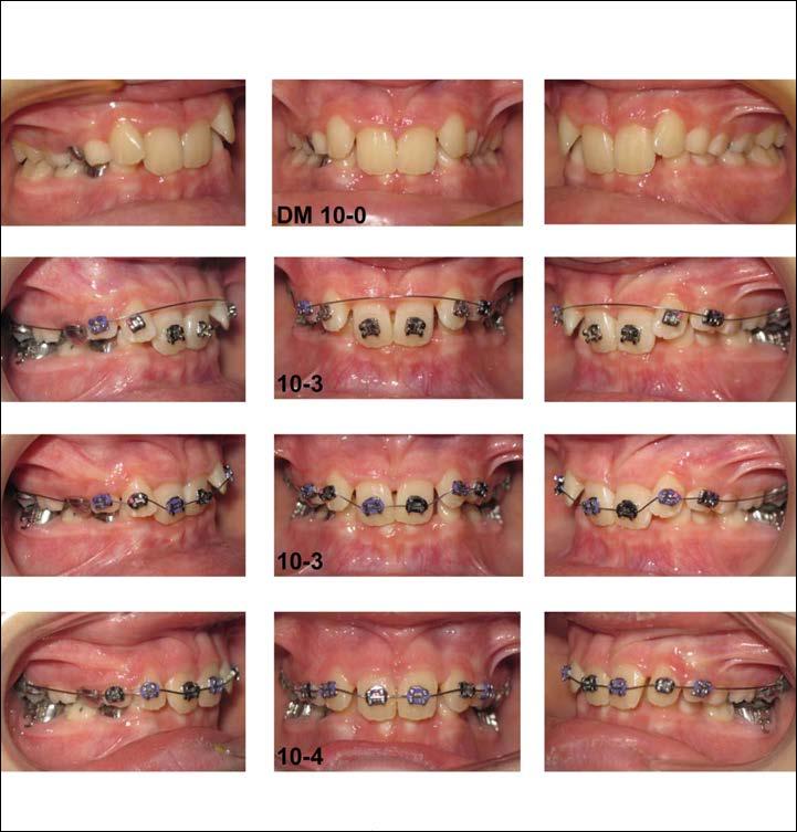 Likewise, early intrusion of permanent incisors eliminates the need for bite planes or bite turbos *** when treating overbites (Figure11). Figure 11.